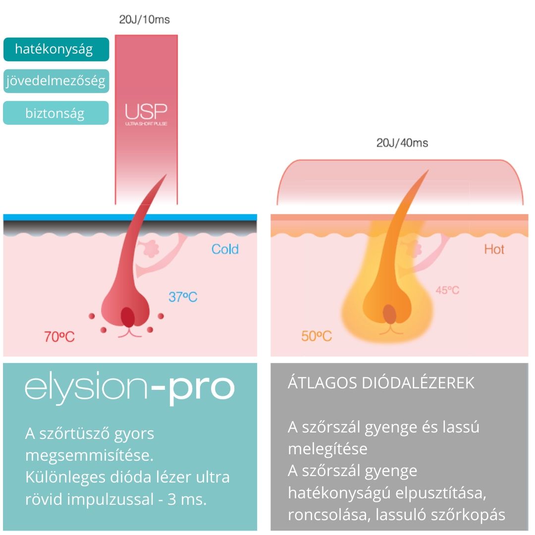 Elysion Pro és az átlagos diódalézeres szőrtelenítők összehasonlítása